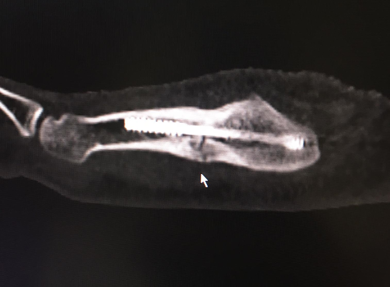 La fracture est clairement visible sur la radiographie